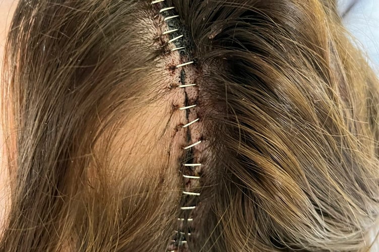 Moli's stitches after brain tumour surgery. Moli said: "I'd booked a holiday with my boyfriend Ollie and we went away to Antalya in October last year. "We'd had a lovely week there, it was really relaxed and there was a water park at the hotel which was great. "I felt absolutely fine and there were no warning signs for what was about to come the day before we were due to fly home. "I'd had trouble sleeping but felt OK apart from that and then I suffered a seizure at around 1am in the morning following by a second one about 20 minutes later.