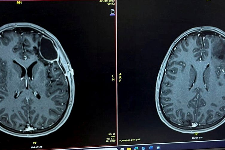 Moli's brain scan revealed she had a tumour. Moli said: "I'd booked a holiday with my boyfriend Ollie and we went away to Antalya in October last year. "We'd had a lovely week there, it was really relaxed and there was a water park at the hotel which was great. "I felt absolutely fine and there were no warning signs for what was about to come the day before we were due to fly home. "I'd had trouble sleeping but felt OK apart from that and then I suffered a seizure at around 1am in the morning following by a second one about 20 minutes later.