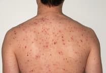 Wales offers chickenpox vaccine to children