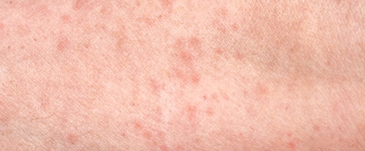 A 'small number' of scabies cases have been confirmed on Llewelyn Ward at Bronllys Hospital, according to Powys Teaching Health Board